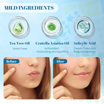 CM 200 Pcs Wholesale Star Style Pimple Patch Hydrocolloid Acne Patches for Face Infused with Tea Tree Oil Centella